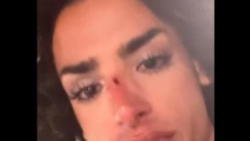 La Policía Nacional investiga la agresión homófoba a un joven en Alicante