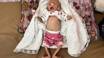 Radiografía del hambre en Gaza: una crisis "pasmosa" que mata como las bombas