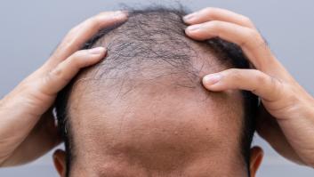 Científicos dan con un prometedor suero con el que se podría decir adiós a la calvicie