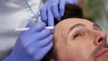 Tres de las mejores clínicas de injerto capilar en Barcelona