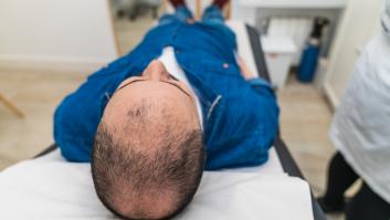 Un joven se somete a un trasplante capilar y los resultados dejan mucho que desear: "Después de dos días, parecía Megamind"