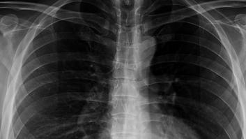 "Sentía cómo se movía entre mis costillas": acaba en urgencias tras tragarse una cuchara de 17 centímetros entera