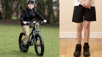 Alfie Phillips, el primer paciente en someterse a una cirugía pionera para alargar su pierna