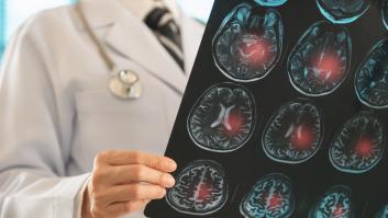 Doctor Bueno: "Ni se te ocurra ignorar un hormigueo en las manos al levantarte: puede ser el aviso previo de un ictus, igual que la angina lo es del infarto"