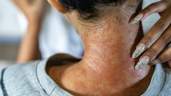 Mujer rascándose la piel con picazón en la nuca.