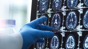 Investigadores británicos identifican seis síntomas depresivos en la mediana edad que aumentan hasta un 50% el riesgo de demencia