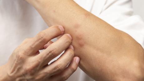 Ni repelentes ni cremas: hay otro método muy sencillo, tradicional y efectivo para aliviar las picaduras de mosquitos, que este año se han adelantado