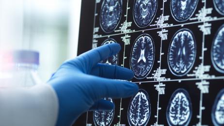 Investigadores británicos identifican seis síntomas depresivos en la mediana edad que aumentan hasta un 50% el riesgo de demencia