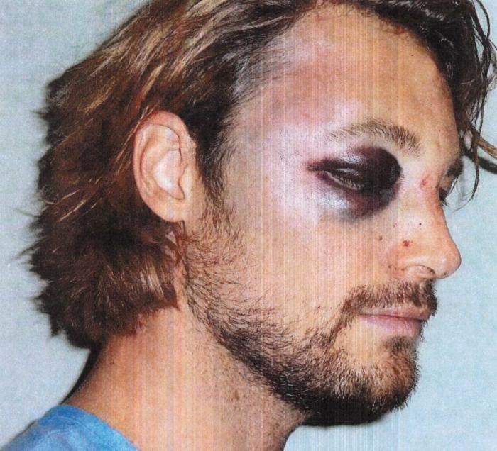 Pelea en casa de Halle Berry: así quedó Gabriel Aubry tras acabar a golpes con Olivier Martínez (FOTOS)