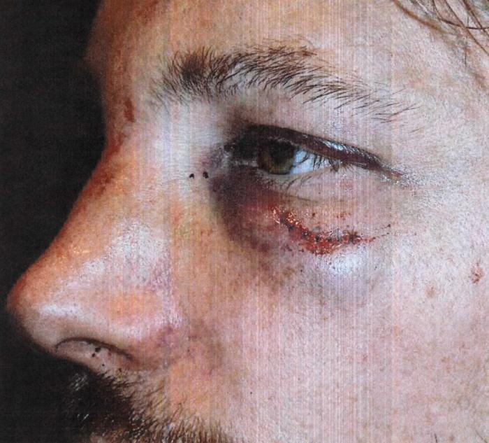 Pelea en casa de Halle Berry: así quedó Gabriel Aubry tras acabar a golpes con Olivier Martínez (FOTOS)