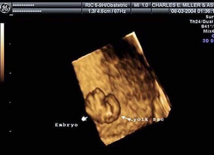 Vídeo del primer año de un bebé prematuro