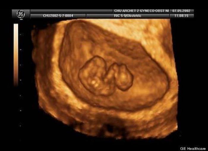 Vídeo del primer año de un bebé prematuro