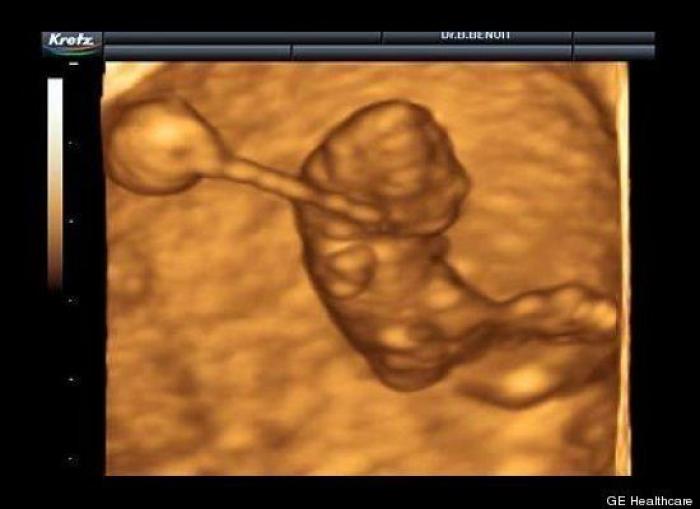 Vídeo del primer año de un bebé prematuro