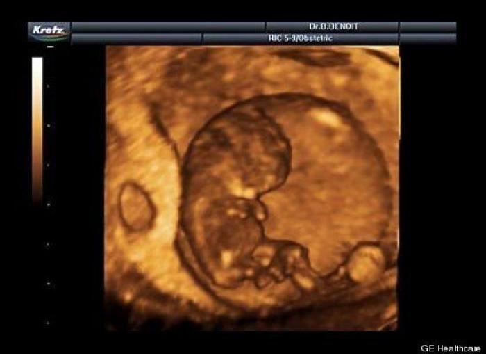 Vídeo del primer año de un bebé prematuro