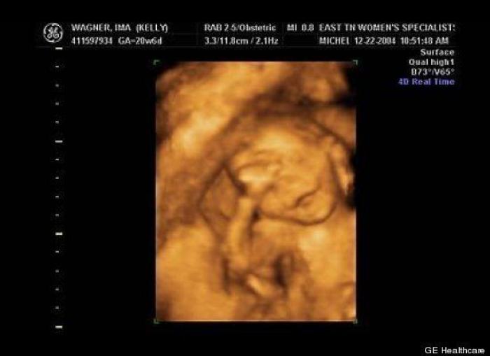 Vídeo del primer año de un bebé prematuro