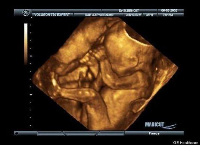 Vídeo del primer año de un bebé prematuro