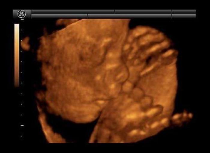 Vídeo del primer año de un bebé prematuro