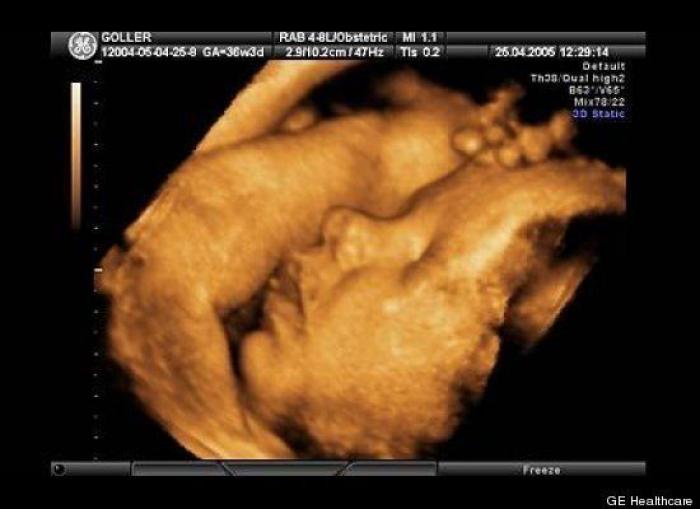 Vídeo del primer año de un bebé prematuro