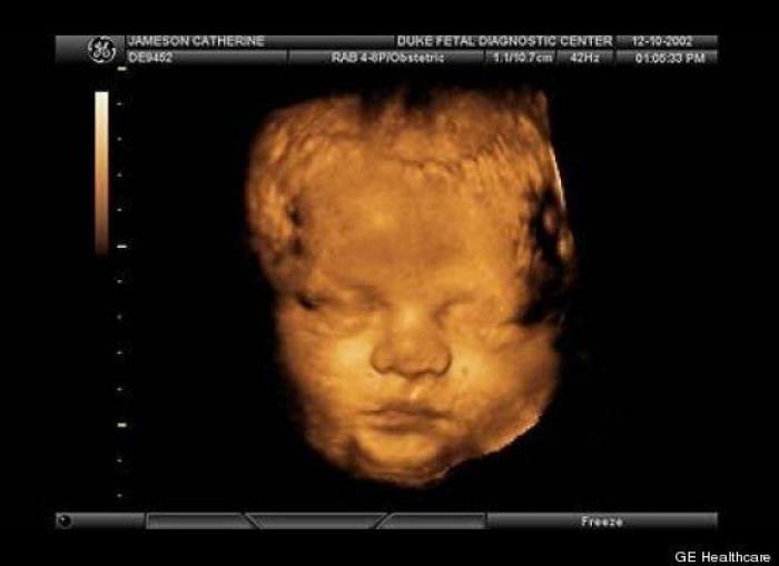 Vídeo del primer año de un bebé prematuro