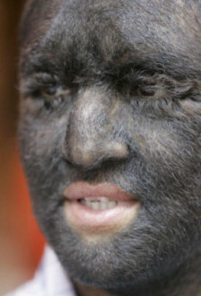 La realidad de la fibromialgia: una enfermedad que va más allá del dolor