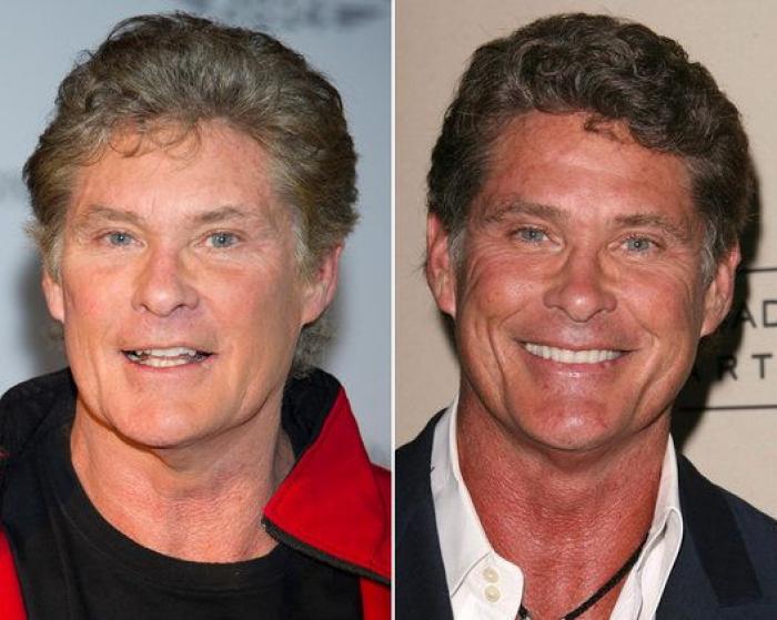 Qué pueden hacer los padres si sus hijos quieren someterse a una cirugía estética