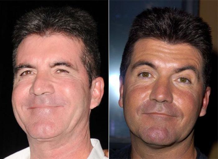 Qué pueden hacer los padres si sus hijos quieren someterse a una cirugía estética