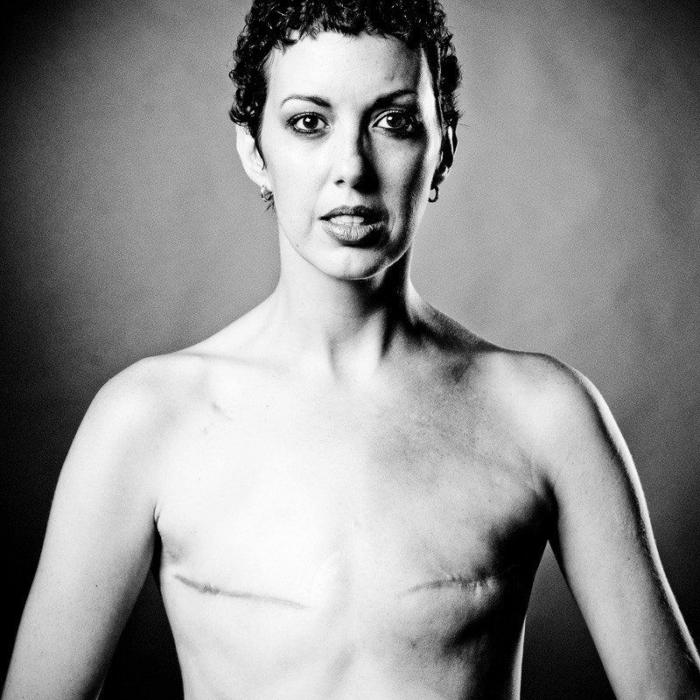Proyecto Cicatriz: 12 fotos de mujeres reales tras vencer el cáncer de mama (FOTOS)