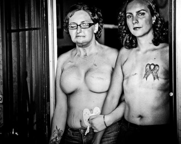 Proyecto Cicatriz: 12 fotos de mujeres reales tras vencer el cáncer de mama (FOTOS)