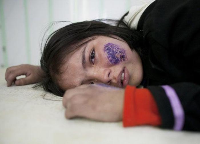 Leishmaniasis, la enfermedad que se está cebando con los refugiados de Oriente Medio