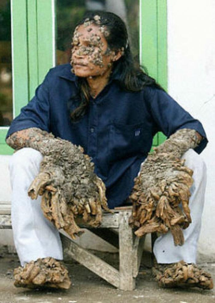 La realidad de la fibromialgia: una enfermedad que va más allá del dolor