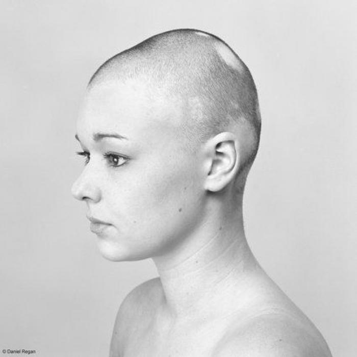 Una joven con alopecia celebra su calvicie con una sesión de fotos