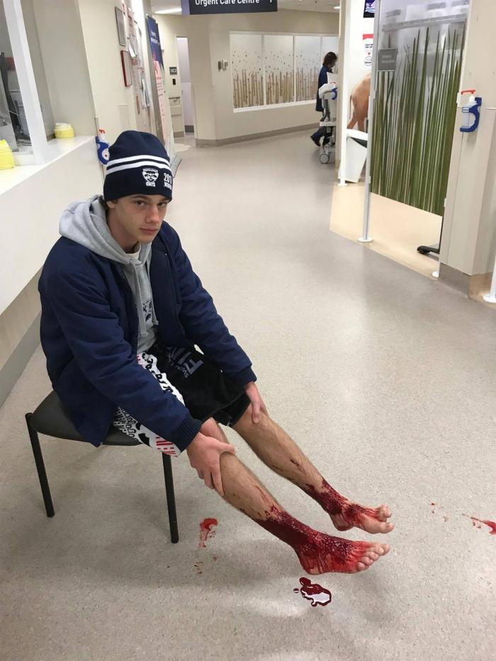 Un joven sale del mar con las piernas devoradas por unas pequeñas criaturas marinas en Australia