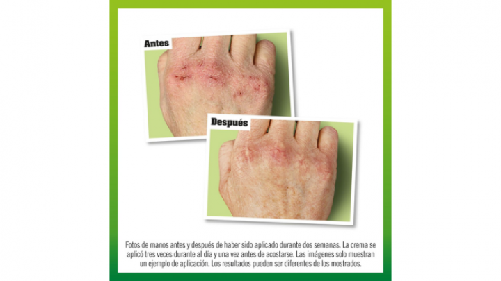 La mejor crema para manos agrietadas, antes y después de usar la crema de manos