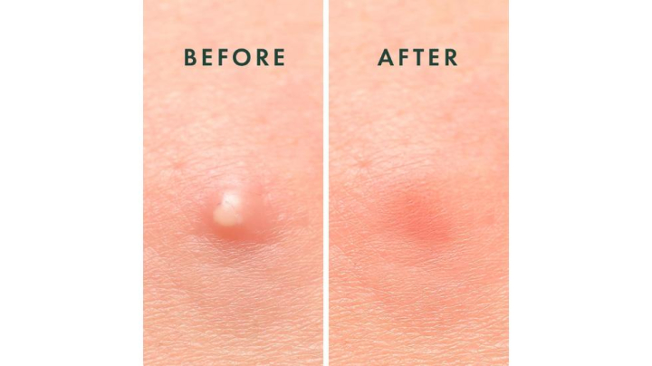 Los mejores parches para los granos del mercado