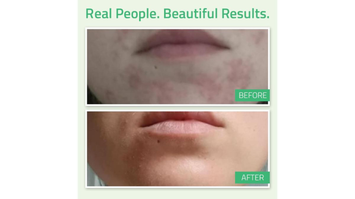 Este es uno de los mejores sérums con retinol para las marcas de acné