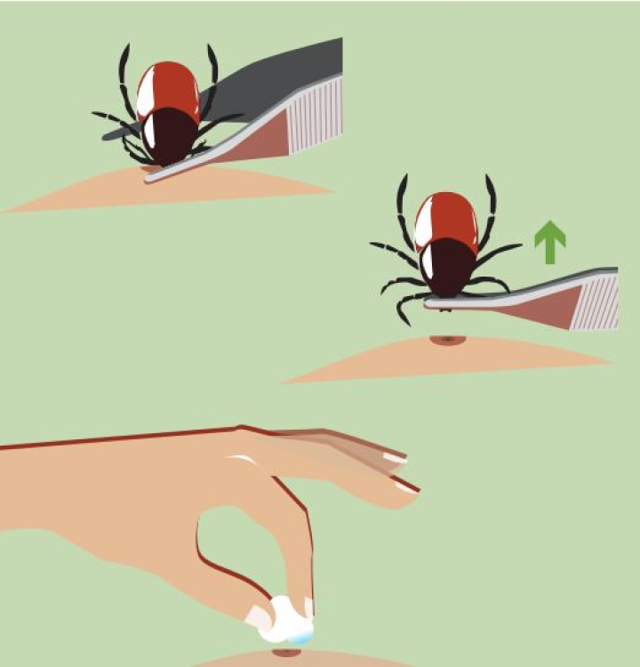 Infografía para la extracción de una garrapata