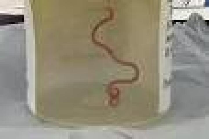 Imagen del gusano que fue extraído del cerebro de una mujer en un hospital de Canberra (Australia).