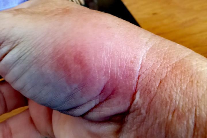 Imagen de archivo de una picadura de mosca negra.