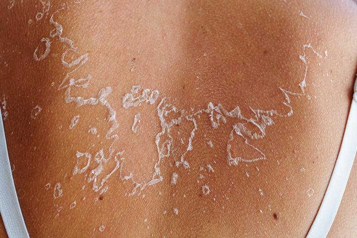 Una espalda quemada por el sol y con la piel pelada.