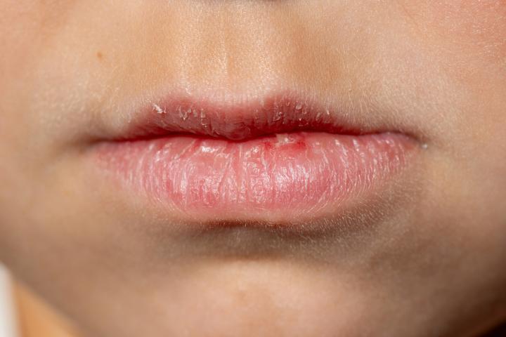 Unos labios secos y agrietados, en una imagen de archivo