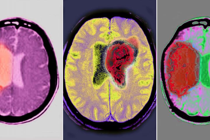 Resonancias cerebrales que muestran distintos tipos de ictus.