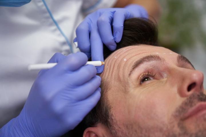 Injerto capilar.
