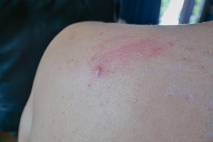 Picadura de araña en una imagen de archivo