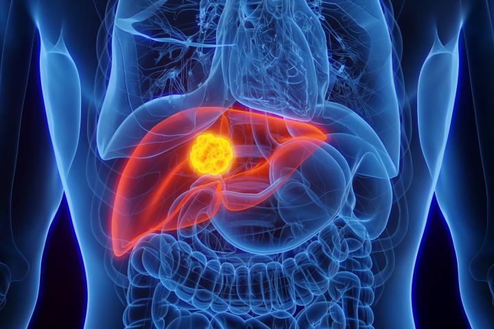 Vista del cáncer de hígado.