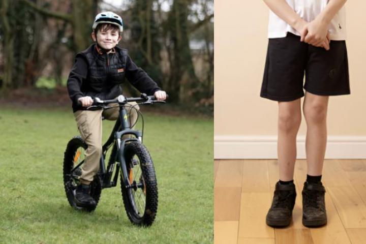 Alfie Phillips, el primer paciente en someterse a una cirugía pionera para alargar su pierna