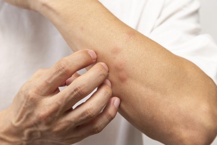 Un hombre se rasca una picadura de mosquito.