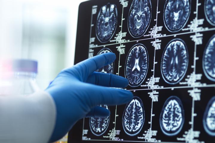 Un médico examina una tomografía cerebral para detectar posibles signos de envejecimiento y enfermedades.
