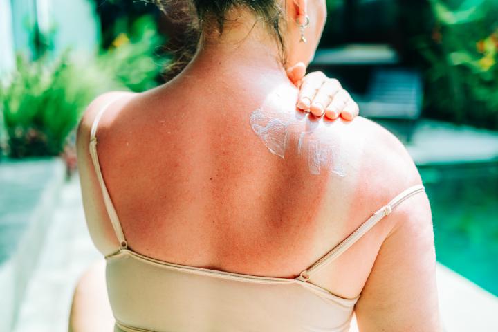 Mujer aplicándose crema en los hombros y la espalda doloridos por las quemaduras solares.