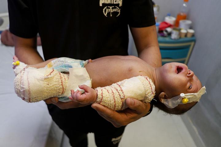 Un bebé mutilado tras un ataque israelí que impactó en una tienda de campaña en el campo de refugiados de Al-Mawasi, en el hospital de Khan Younis (Gaza), el 4 de junio de 2026.