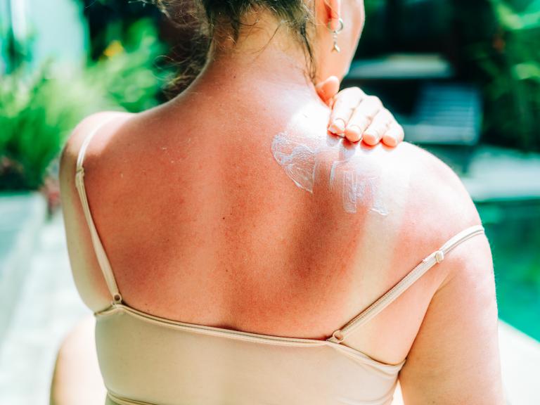Mujer aplicándose crema en los hombros y la espalda doloridos por las quemaduras solares.